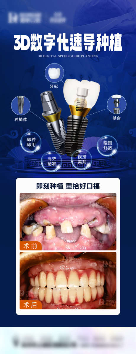 种植牙案例海报_源文件下载_PSD格式_1080X2801像素-口腔,牙科,牙齿,对比,海报,案例,种植牙-作品编号:2023122717231963-志设-zs9.com