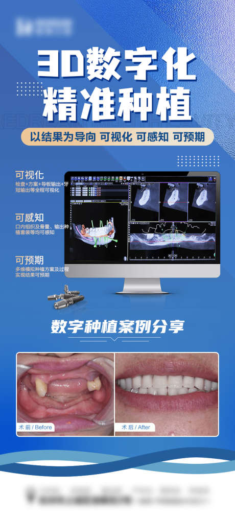 数字化种植_源文件下载_PSD格式_750X1654像素-技术,对比,案例,牙齿,种植牙,数字化,医疗,口腔,牙科,海报-作品编号:2024010415296511-源文件库-ywjfx.cn